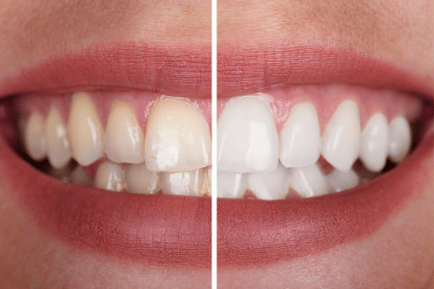Tam Ağız Diş Rekonstrüksiyonu Rehberi · Livera Dental Clinic Florya İstanbul