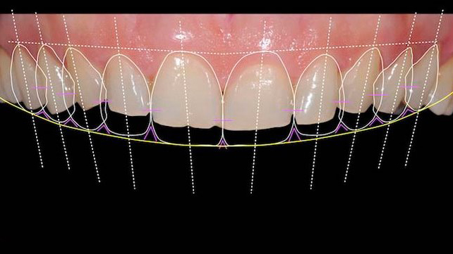 What is Digital Smile Design? A Comprehensive Overview · Livera Dental Clinic Florya Istanbul