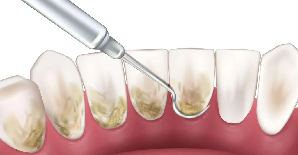 Gum Disease Что вызывает заболевания дёсен? · Livera Dental Clinic Флория Стамбул