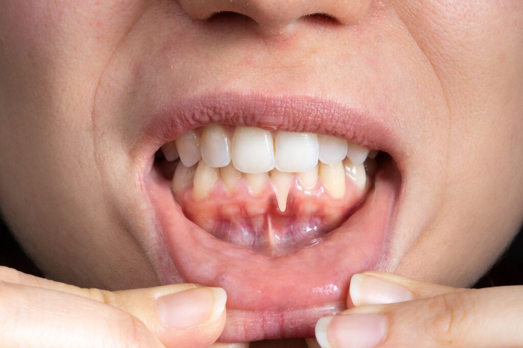 Воспаление дёсен: симптомы и методы лечения · Livera Dental Clinic Флория Стамбул
