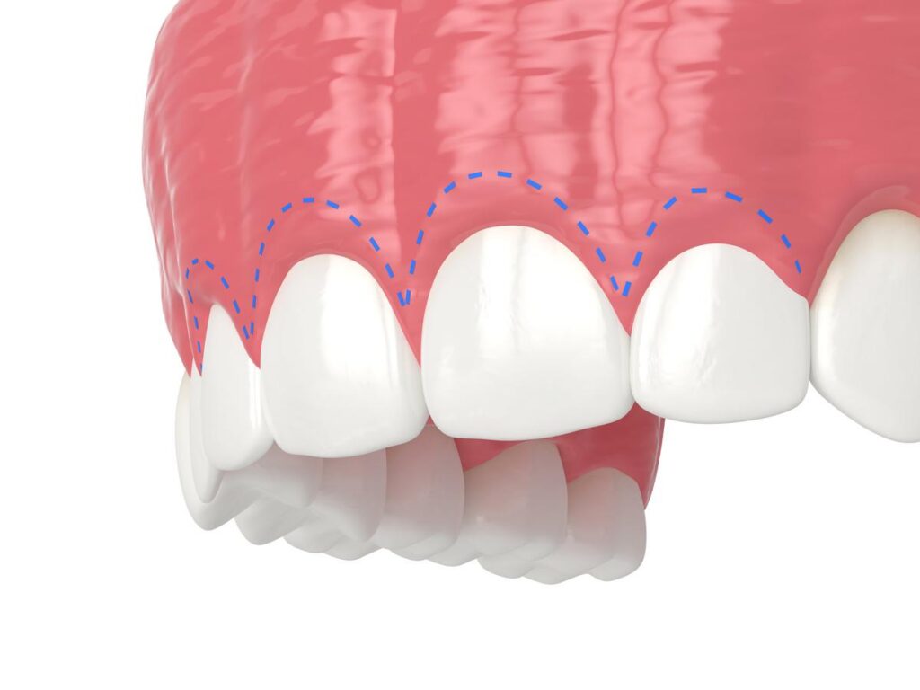 Future Actions Regarding Gummy Smile · Livera Dental Clinic Florya Istanbul