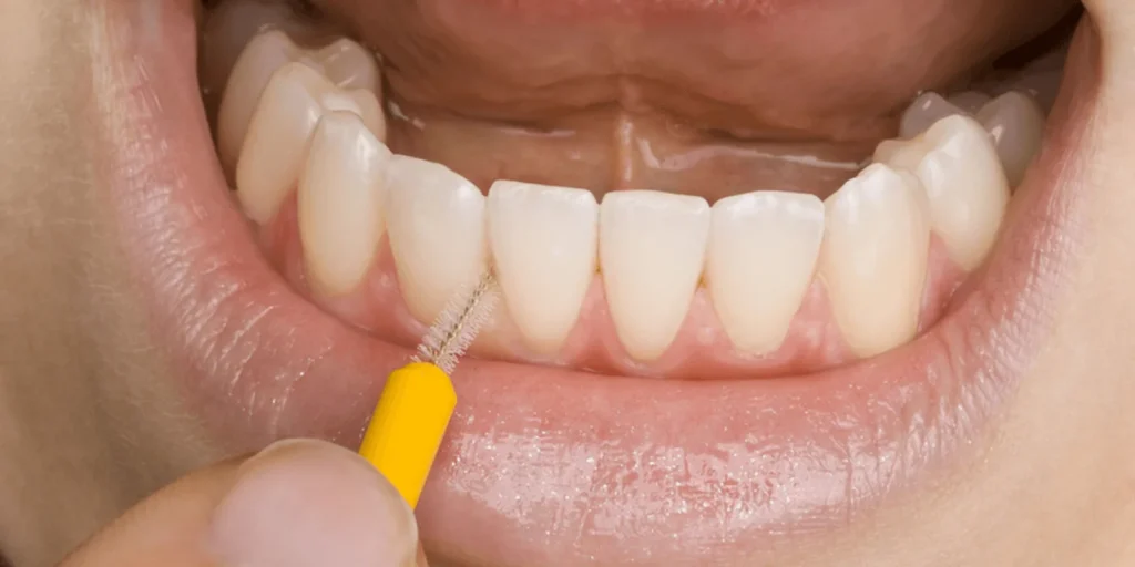 What is an Interface Brush? How is it Used? · Livera Dental Clinic Florya Istanbul