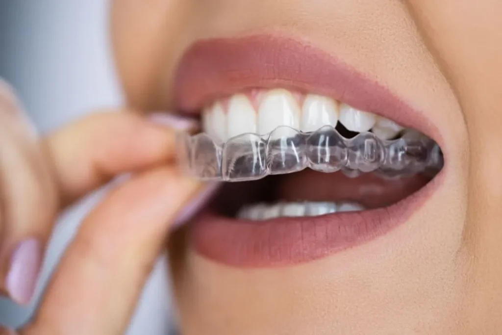 Şeffaf Diş Telleri Nedir ve Ne Amaçla Kullanılır? · Livera Dental Clinic Florya İstanbul