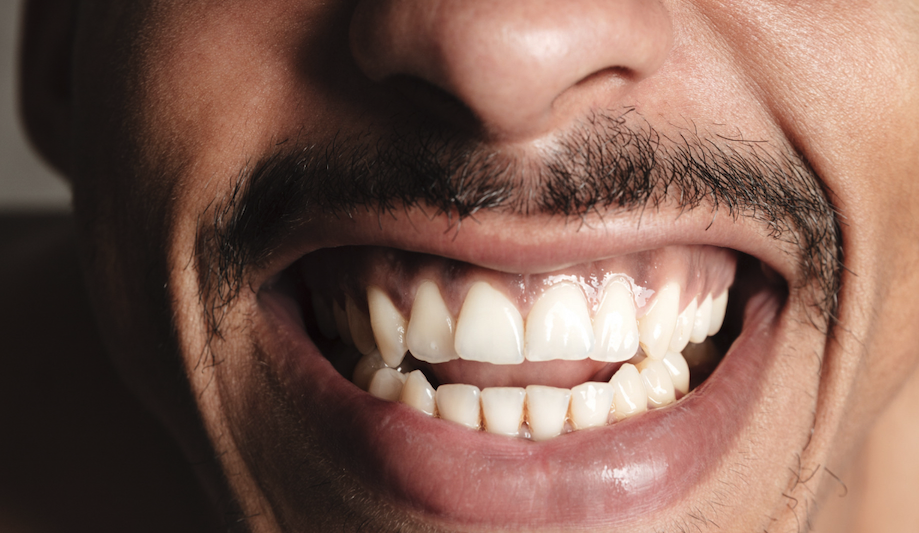 Open Bite: Understanding Causes and Treatment Costs · Livera Dental Clinic Florya Istanbul