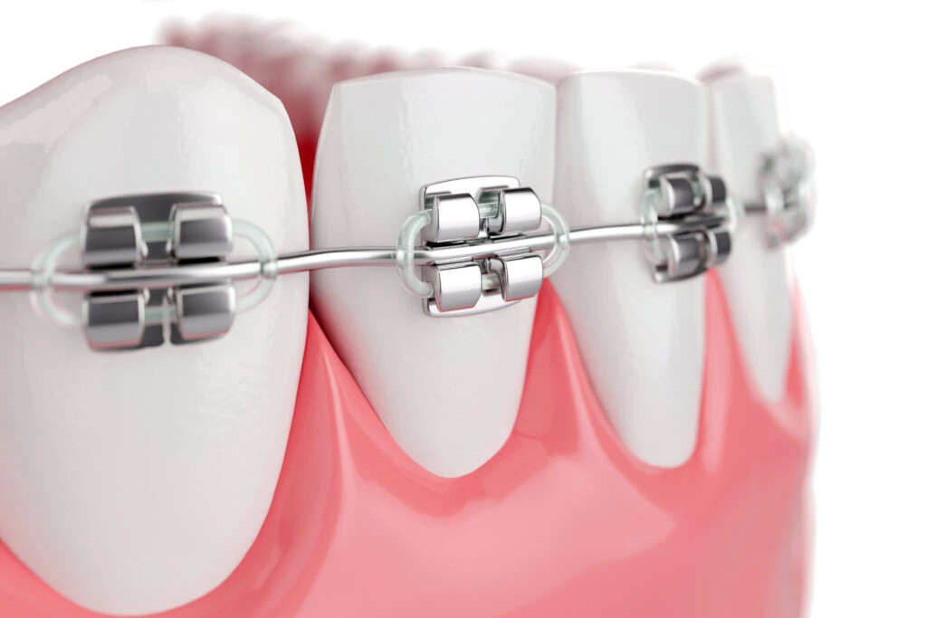 What is Orthodontics? Types, Benefits, and Treatment Options · Livera Dental Clinic Florya Istanbul
