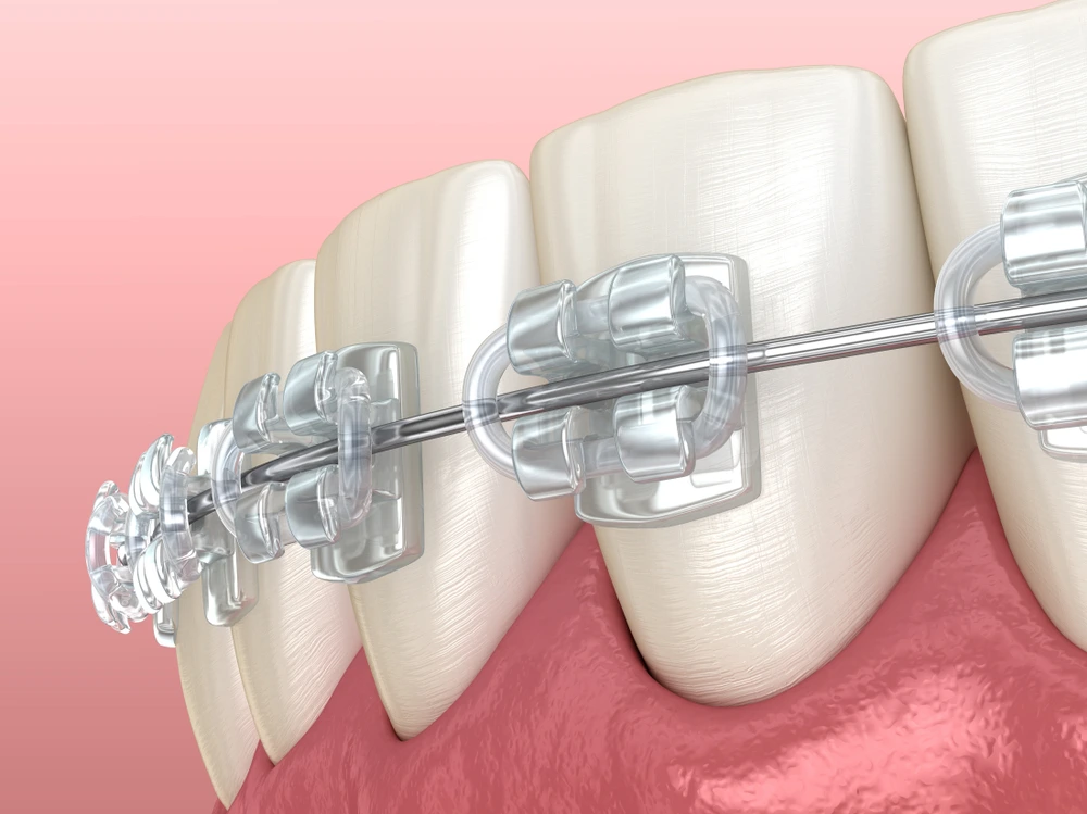 What is Orthodontics? Types, Benefits, and Treatment Options · Livera Dental Clinic Florya Istanbul