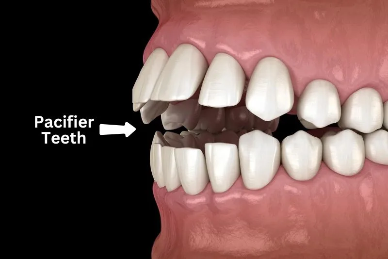 How to Fix Pacifier Teeth? 2 Methods That Work · Livera Dental Clinic Florya Istanbul
