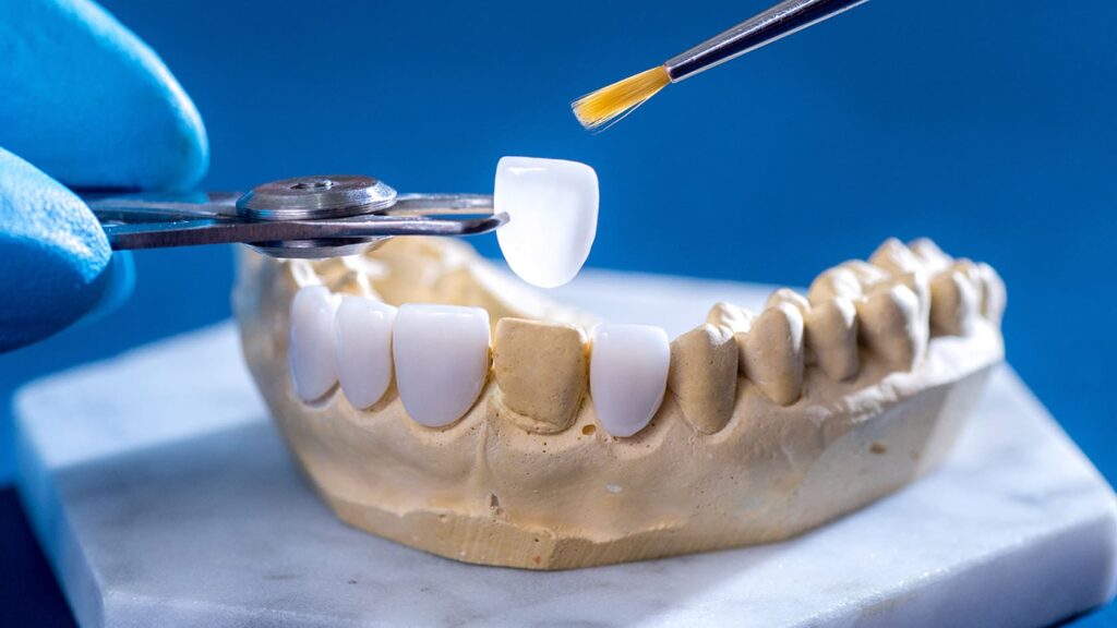 tooth cutting Diş Kesimi Sonrası Nelere Dikkat Edilmeli? · Livera Dental Clinic Florya İstanbul