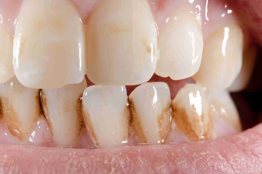 Diş Renklenmesi: Nedenleri, Türleri ve Tedavi Seçenekleri · Livera Dental Clinic Florya İstanbul
