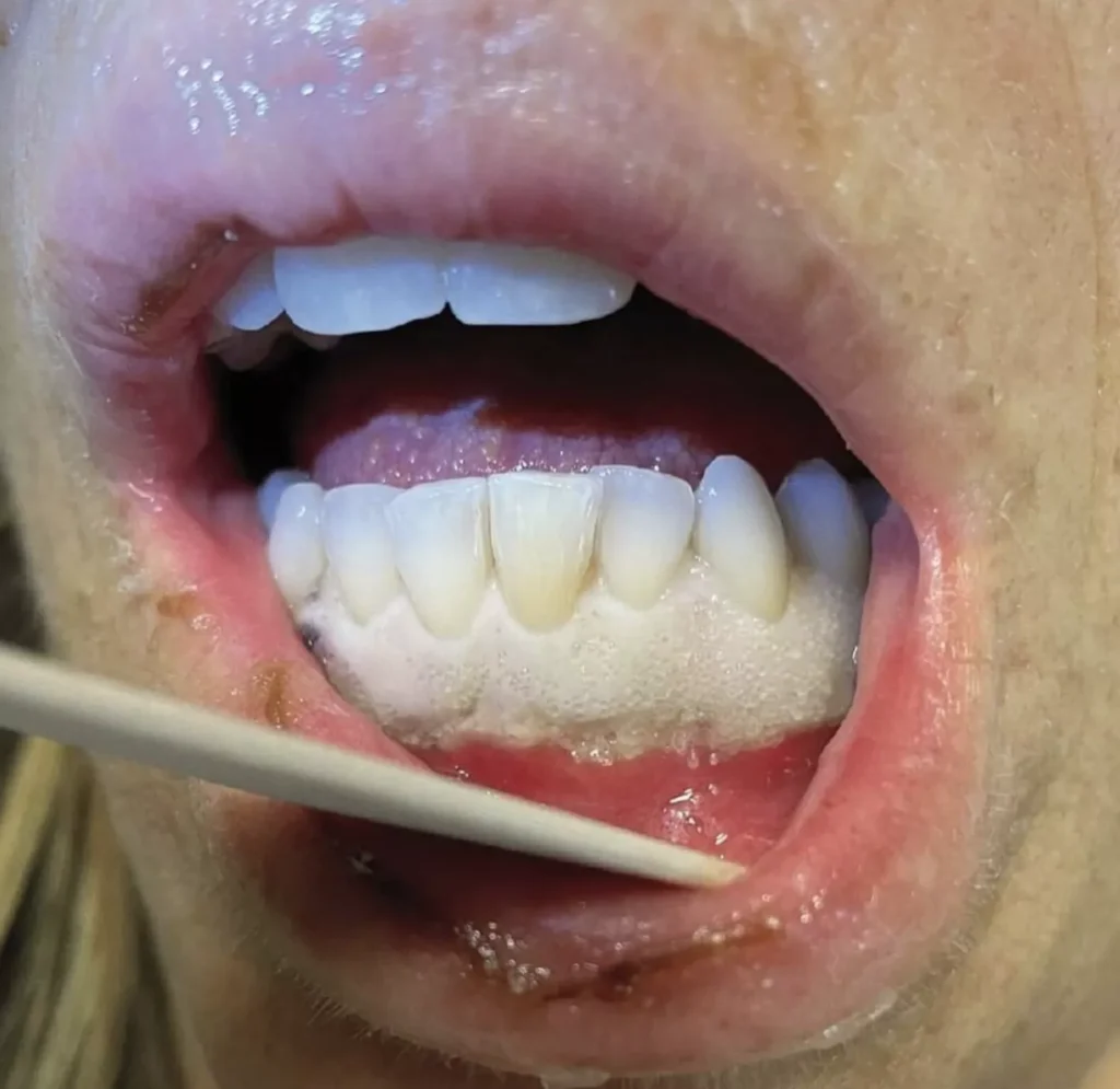 Beyaz Diş Etleri: Nedenleri, Belirtileri ve Tedavi Yaklaşımları · Livera Dental Clinic Florya İstanbul