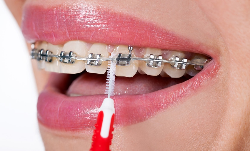 braces How to Avoid Tooth Decay While Wearing Braces · Livera Dental Clinic Florya Istanbul