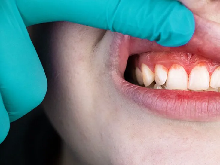 Hassas Dişler İçin Diş Beyazlatma Tedavileri · Livera Dental Clinic Florya İstanbul