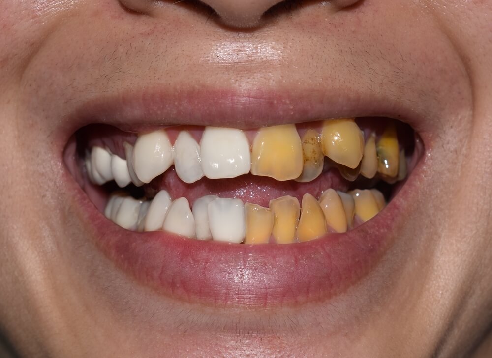 Sararmış Dişler: Deneyebileceğiniz 4 Ev Tedavisi · Livera Dental Clinic Florya İstanbul