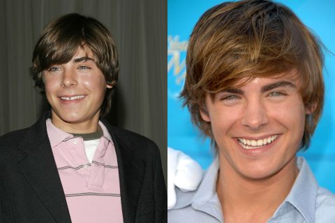 The Early Days of Zac Efron Teeth: The Iconic Gap · Livera Dental Clinic Florya Istanbul