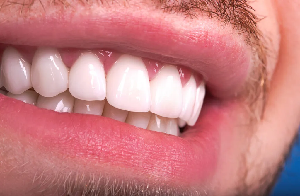 What is Zirconium Coating? How is it Done, and What are the Advantages? · Livera Dental Clinic Florya Istanbul