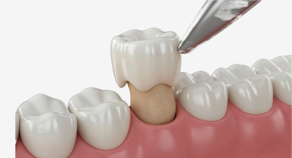 Dental Veneers: 3 Different Types and Their Costs · Livera Dental Clinic Florya Istanbul