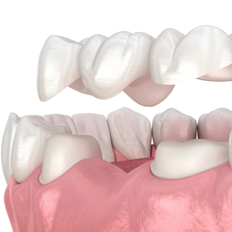 Виниры постоянны? Сколько они служат? · Livera Dental Clinic Флория Стамбул