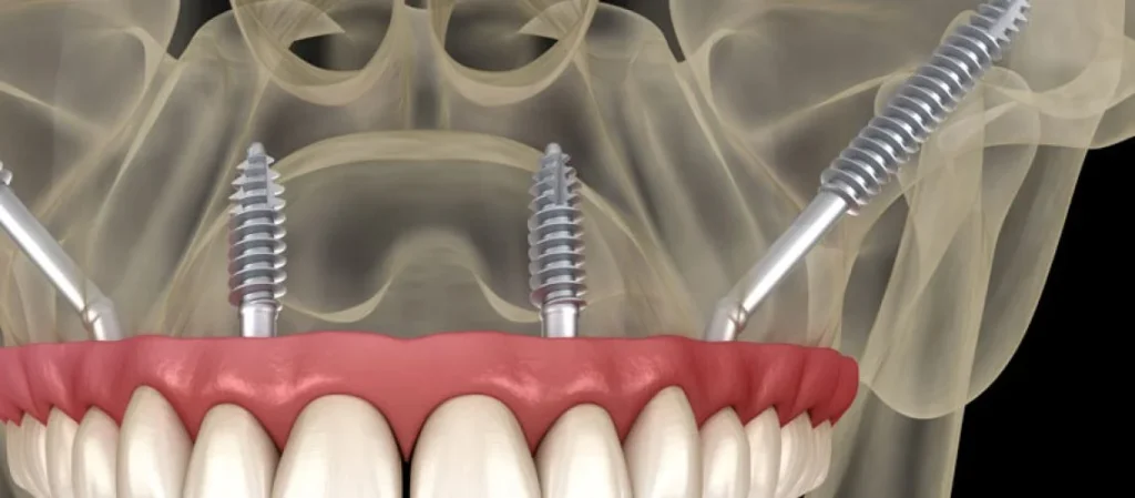 What is a Zygomatic Implant? What are its Advantages? · Livera Dental Clinic Florya Istanbul