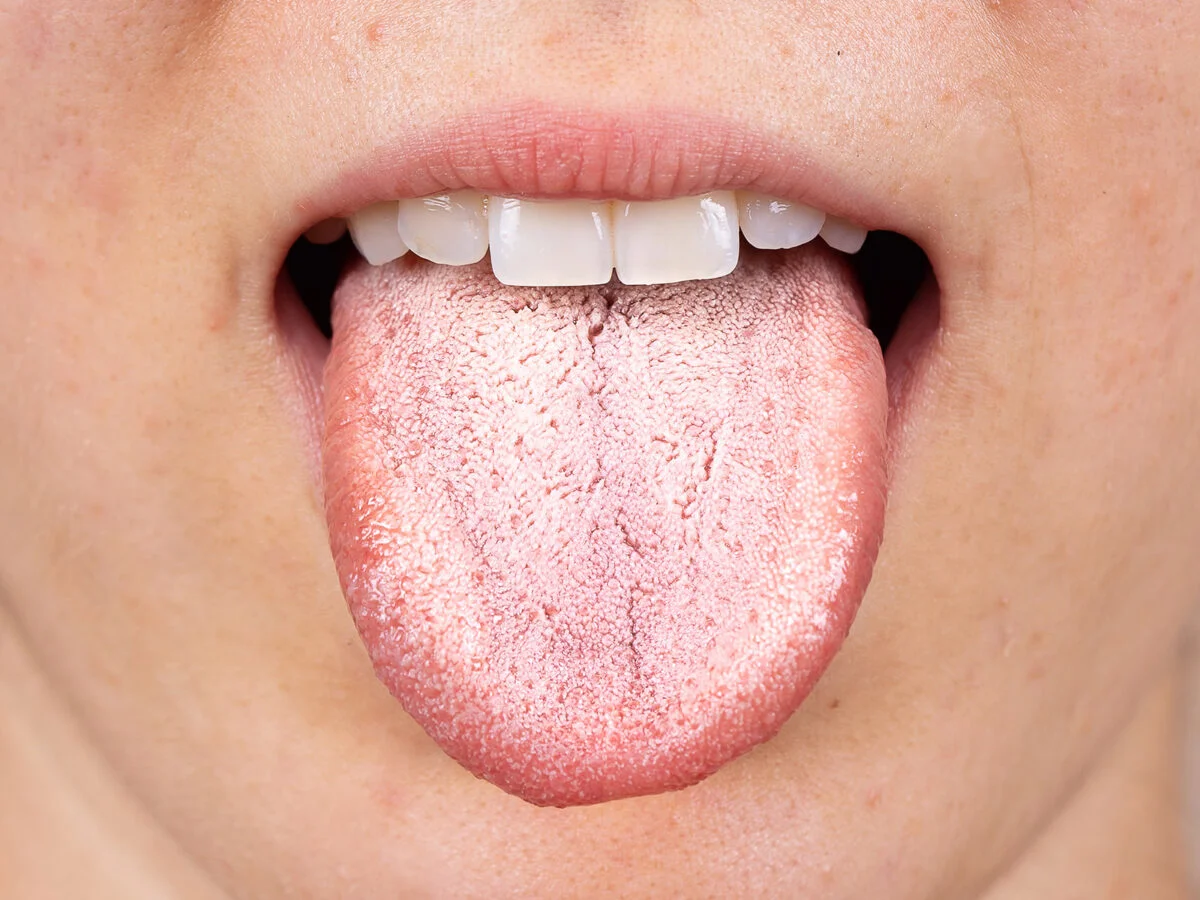 What Causes Dry Mouth and How Can It Be Treated?