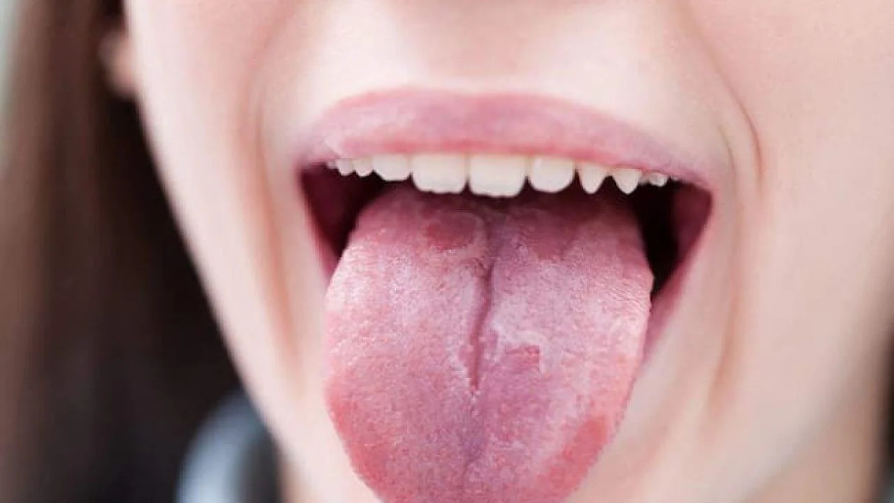 What is Burning Mouth Syndrome? Symptoms and Treatment