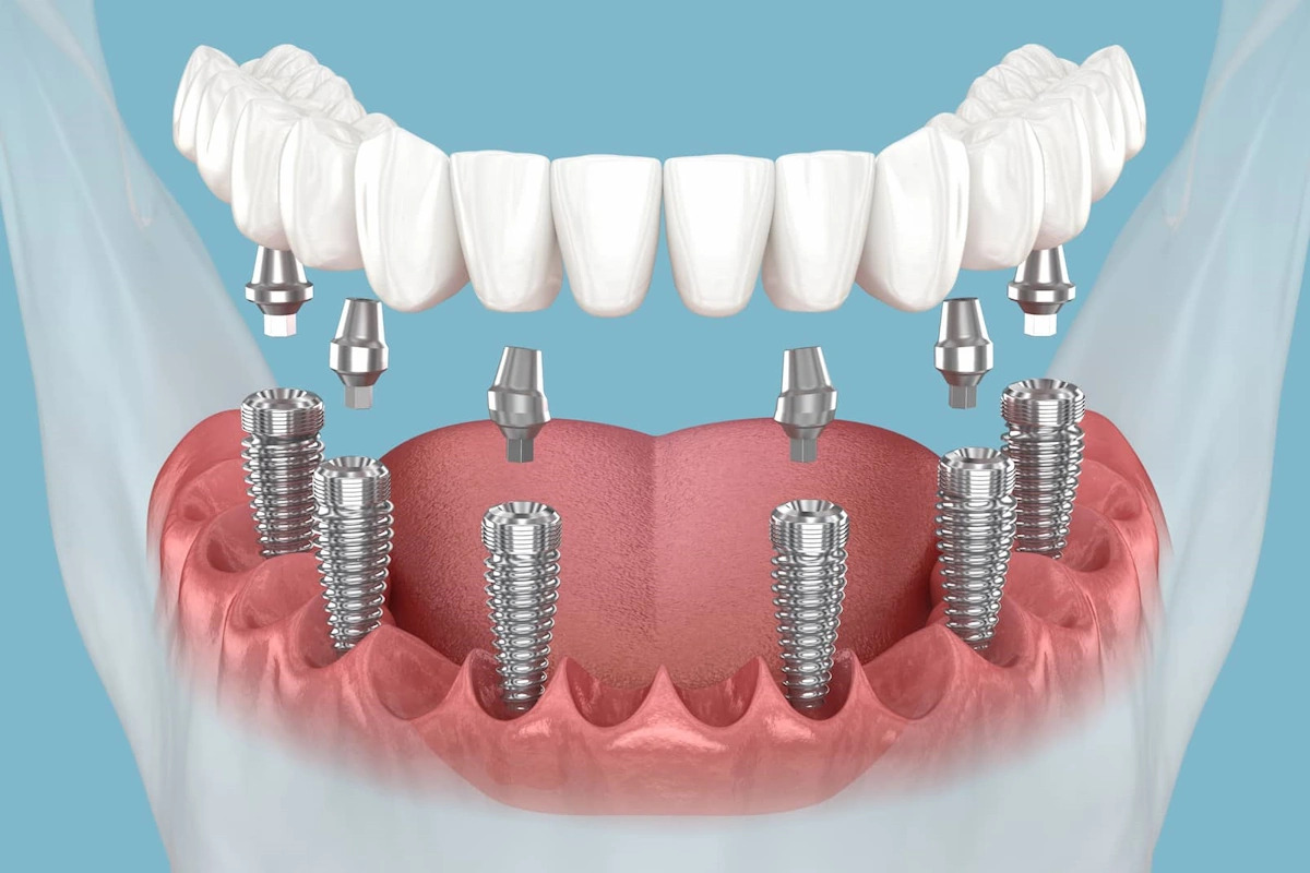 What Is an All-on-6 Implant? Procedure and Costs