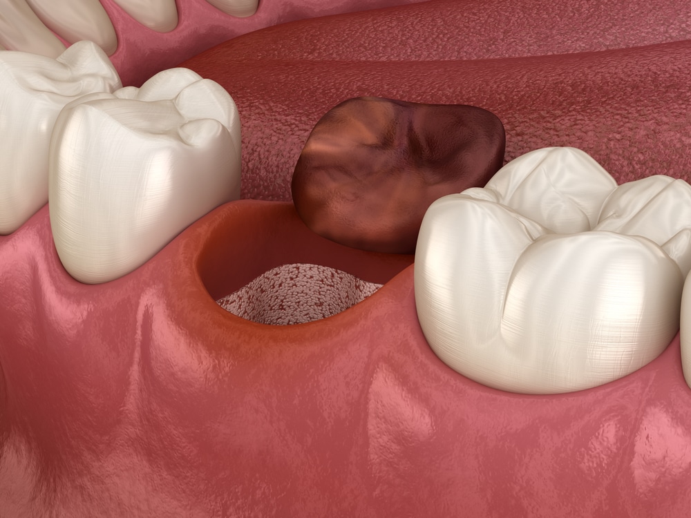 What Is Alveolitis Treatment? How Is It Performed and How Long Does It Take?
