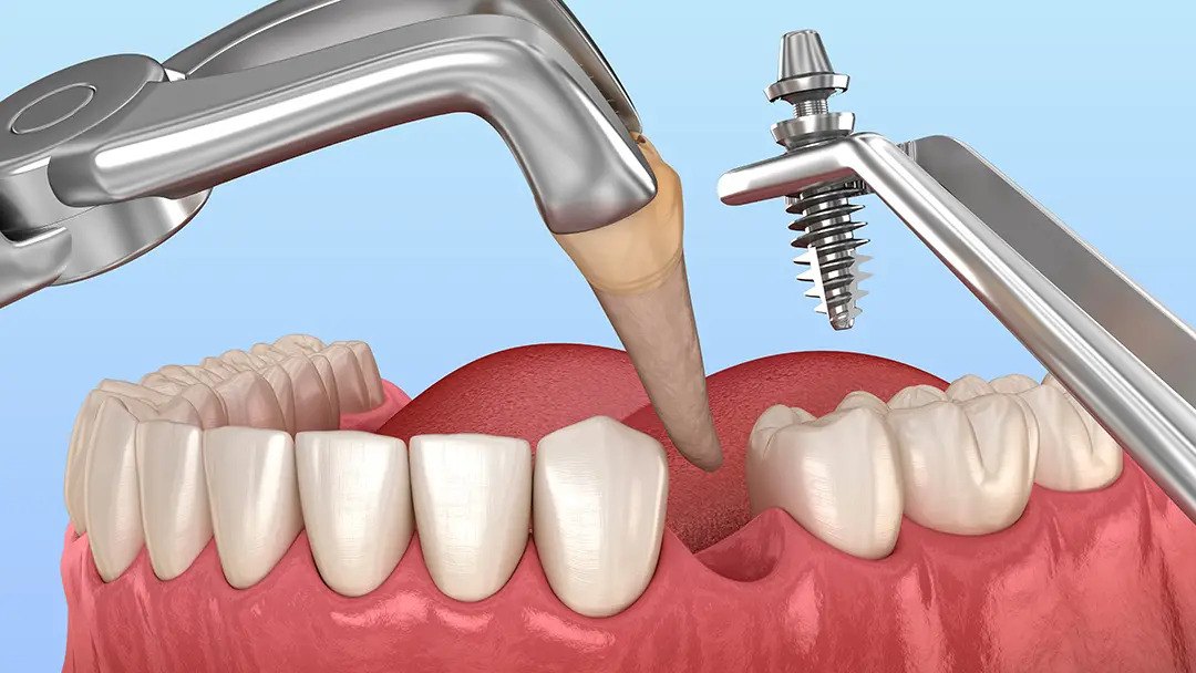 same day implant