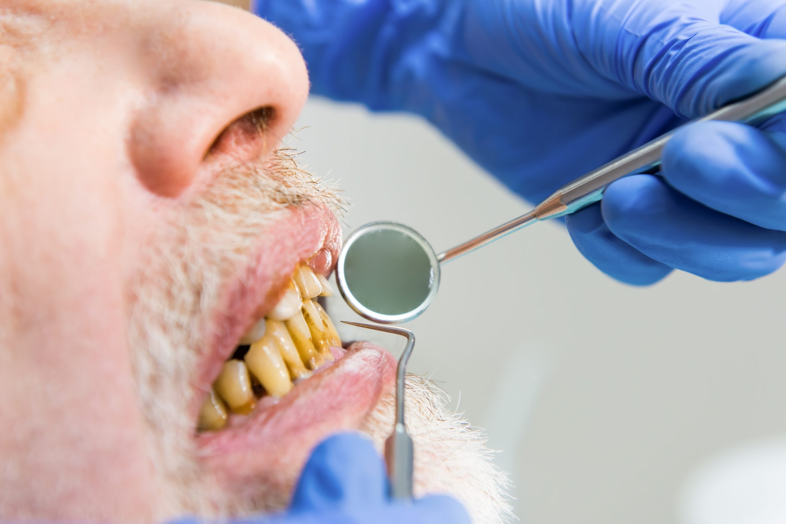 How to Eliminate Bacteria in the Mouth