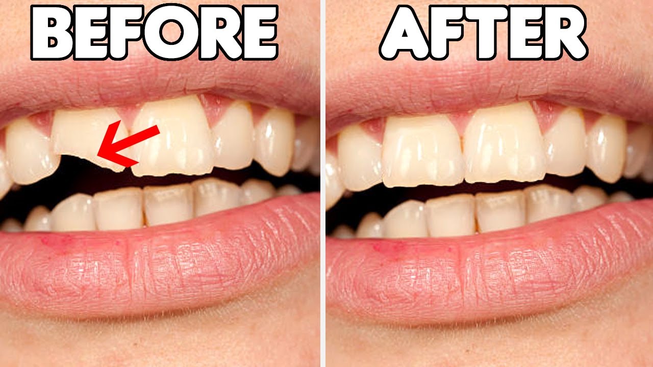 Broken Tooth Repair: Treatment Options and Guidelines
