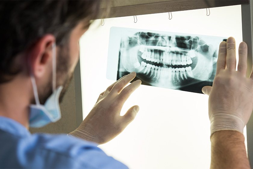 Jawbone Cyst Symptoms and Surgery