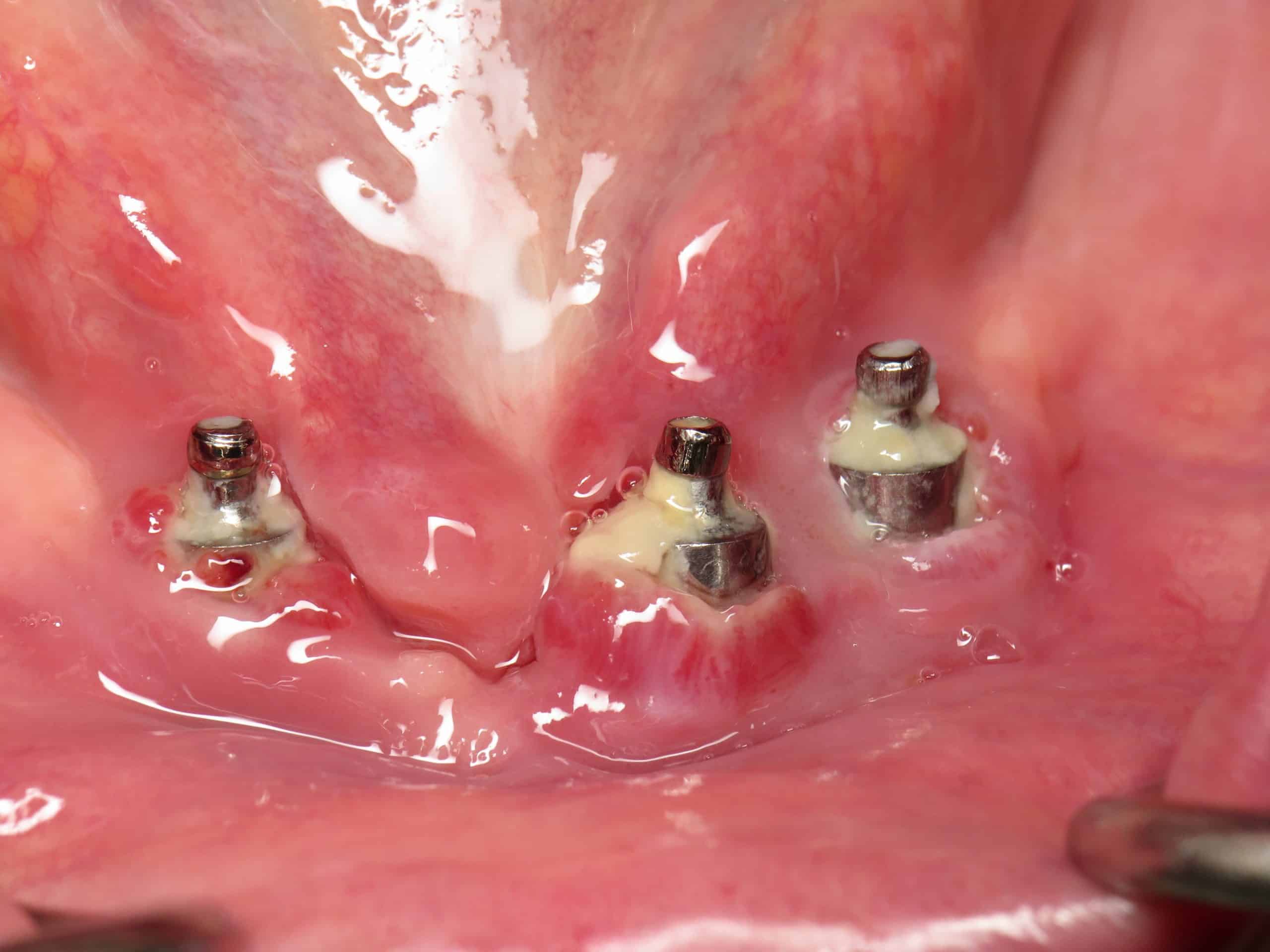 Dental Implant Failure: Myths and Facts About Dental Implant Failure