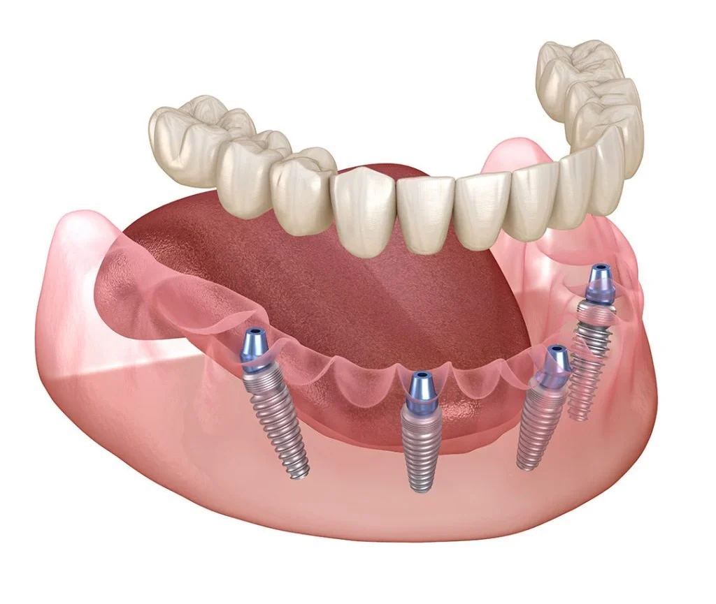 Can You Get a Dental Implant from the NHS?