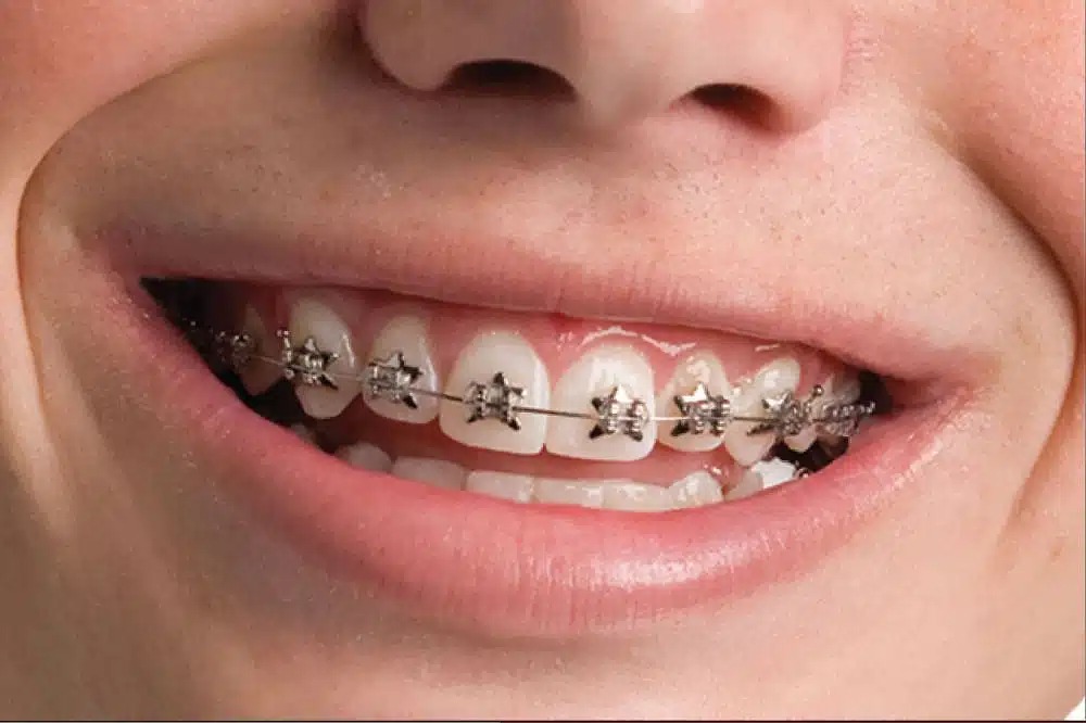 Metal Diş Telleri: Avantajları, Fiyatları ve Çeşitleri