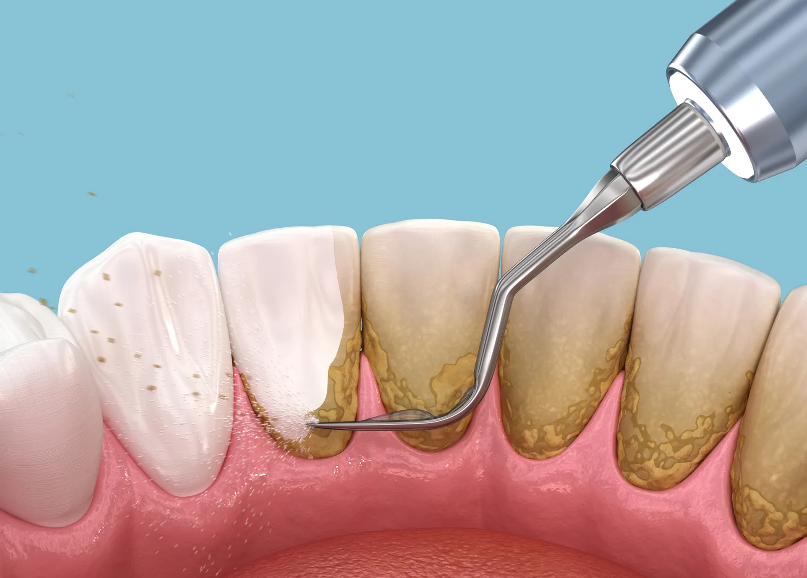 How to Remove Dental Plaque? Important Tips for Healthier Teeth
