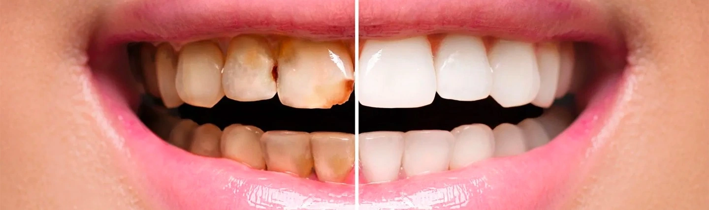 Full Mouth Dental Reconstruction Guide