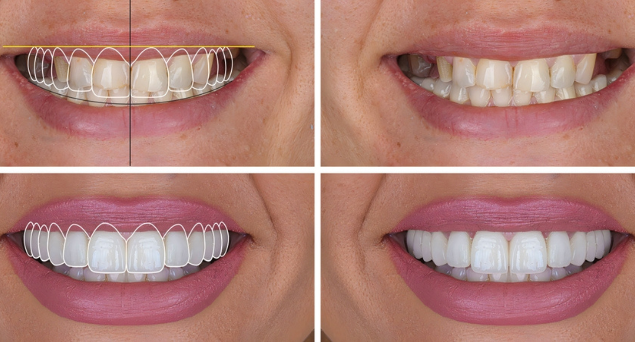 What is Digital Smile Design? A Comprehensive Overview
