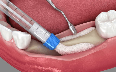 Hojení po transplantaci dásně: fáze, doba a péče