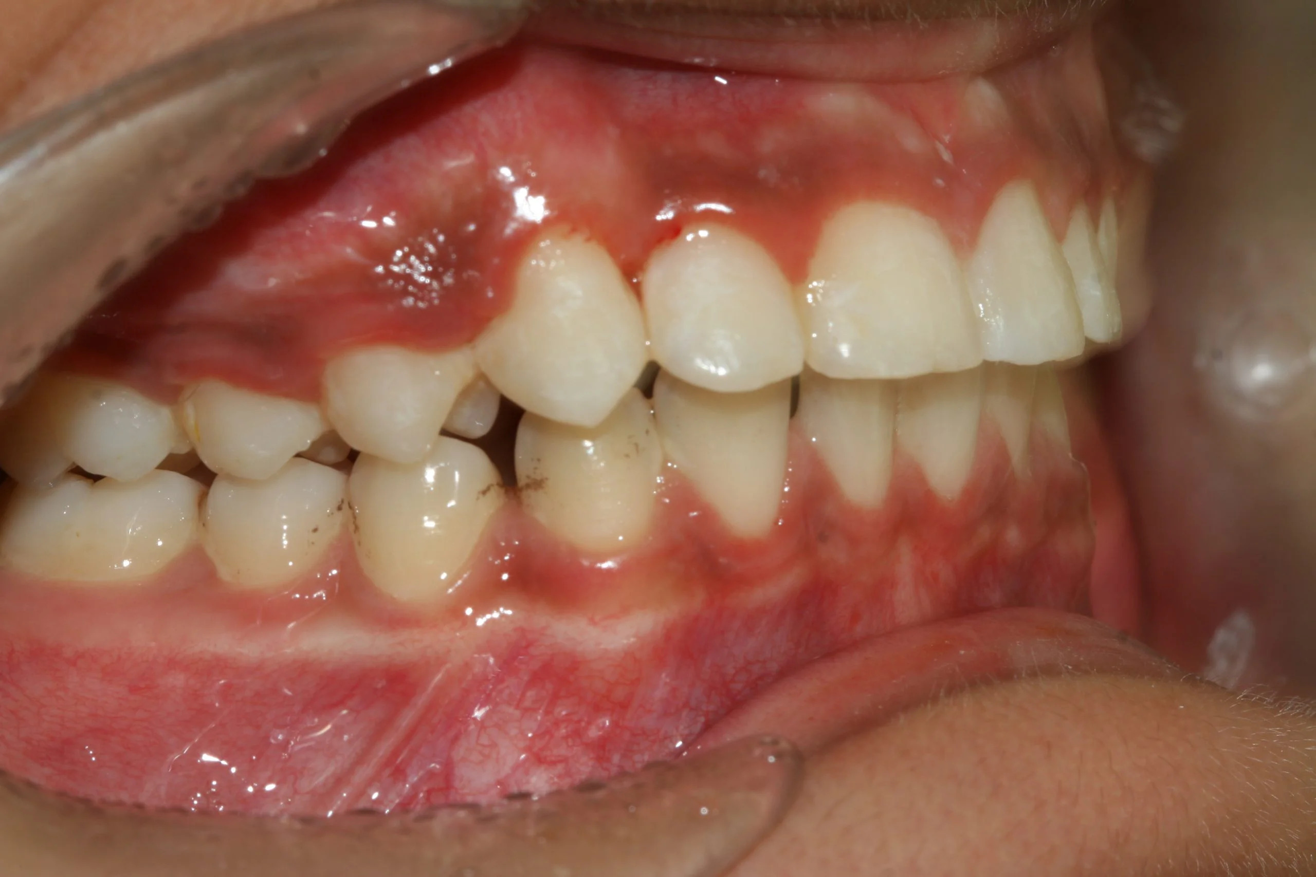 What Causes Gum Darkening? How to Treat It and Available Therapies