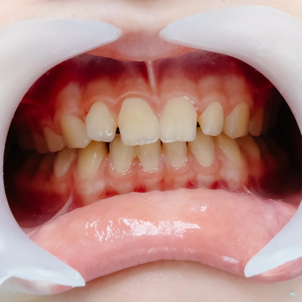 What Is Gum Pigmentation? How Can Gum Discoloration Be Treated?