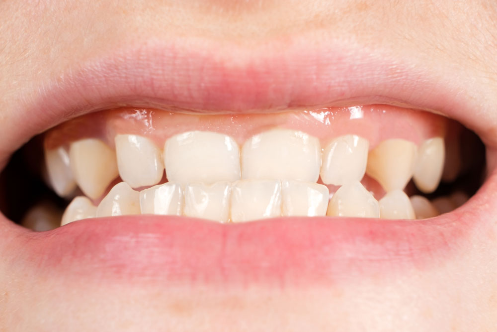 What Causes Teeth Grinding and How Can It Be Stopped?
