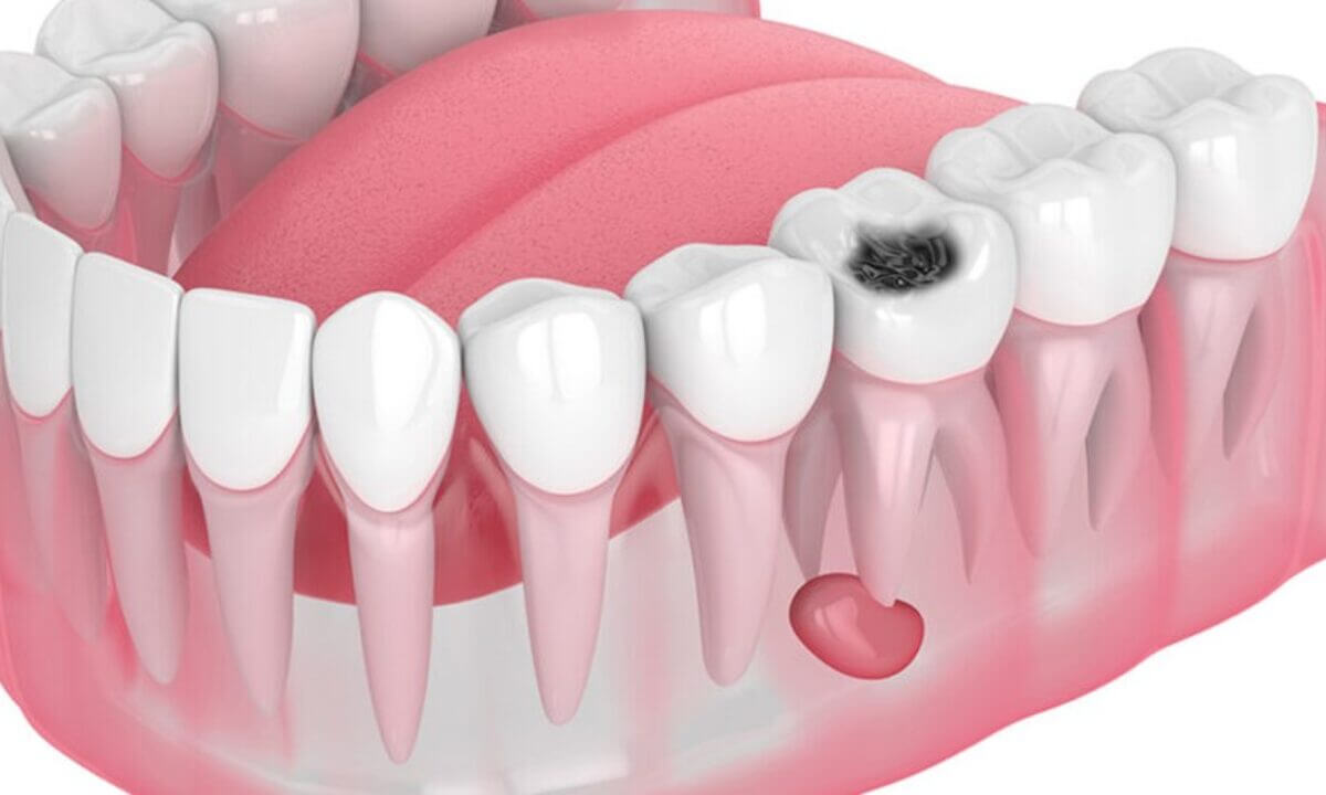 What Is a Tooth Root Cyst? Symptoms and Treatment