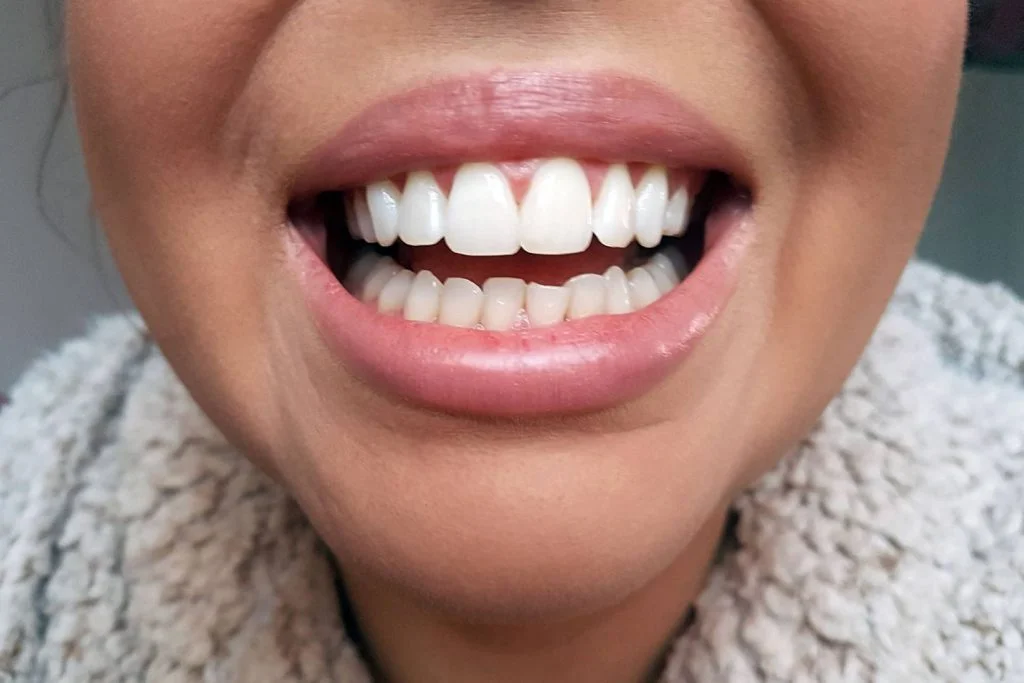 What is Teeth Shaping? How Is It Performed?