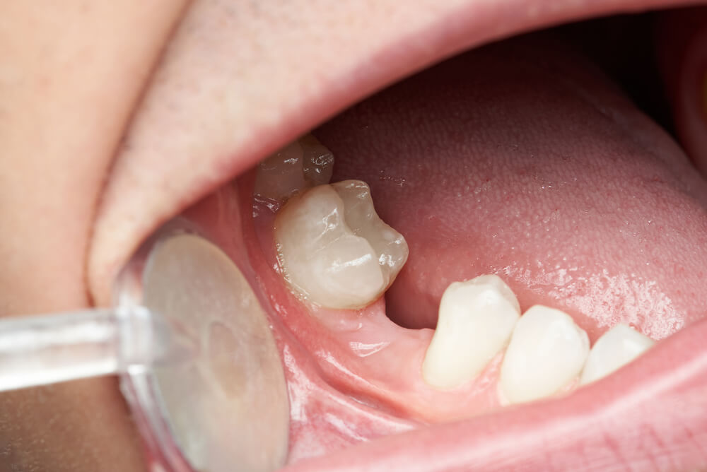 What is Congenital Tooth Loss? Causes and Treatment