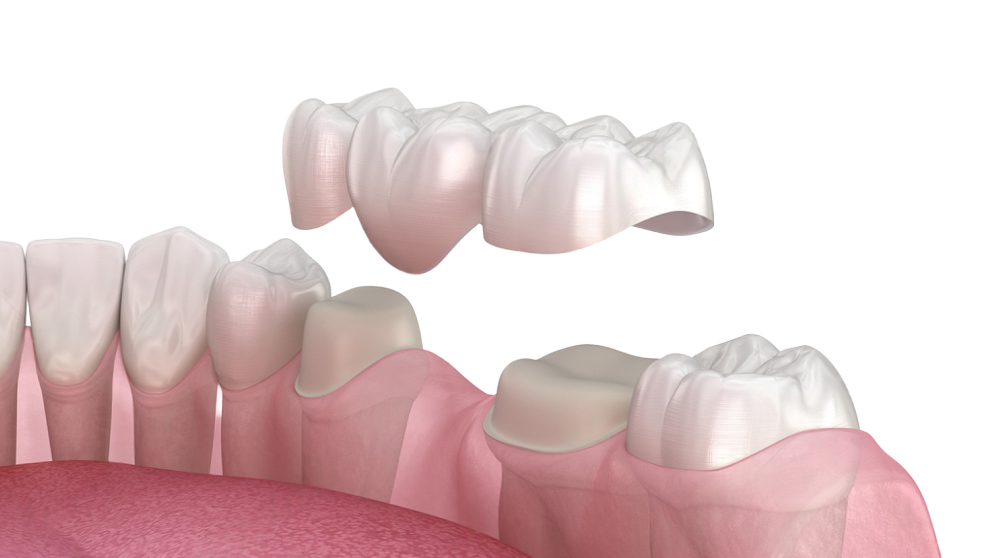Achieve a Stunning Smile with E-Max Crown