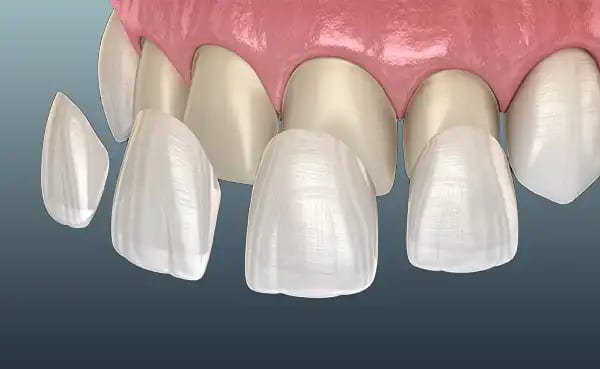 What Is E-Max Veneer? Zirconia Difference & Cost
