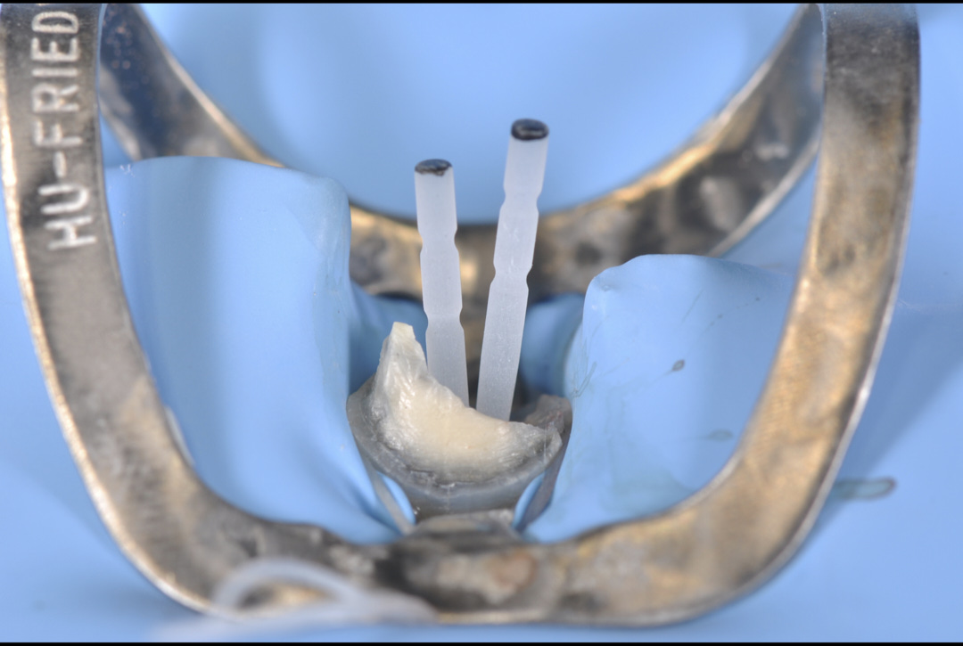 What Is Fiber Post? How Is It Applied to Save a Tooth?