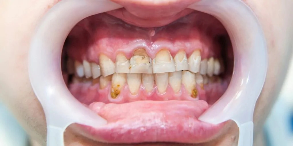 florosis