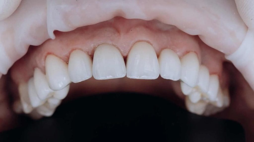 What Is a Temporary Dental Crown? Pain, Dislodgement, and Costs