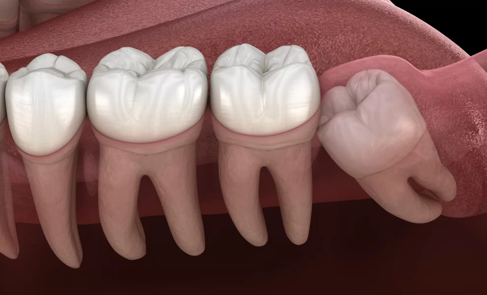 Is Impacted Wisdom Tooth Extraction Difficult? What Happens If It Is Not Extracted?