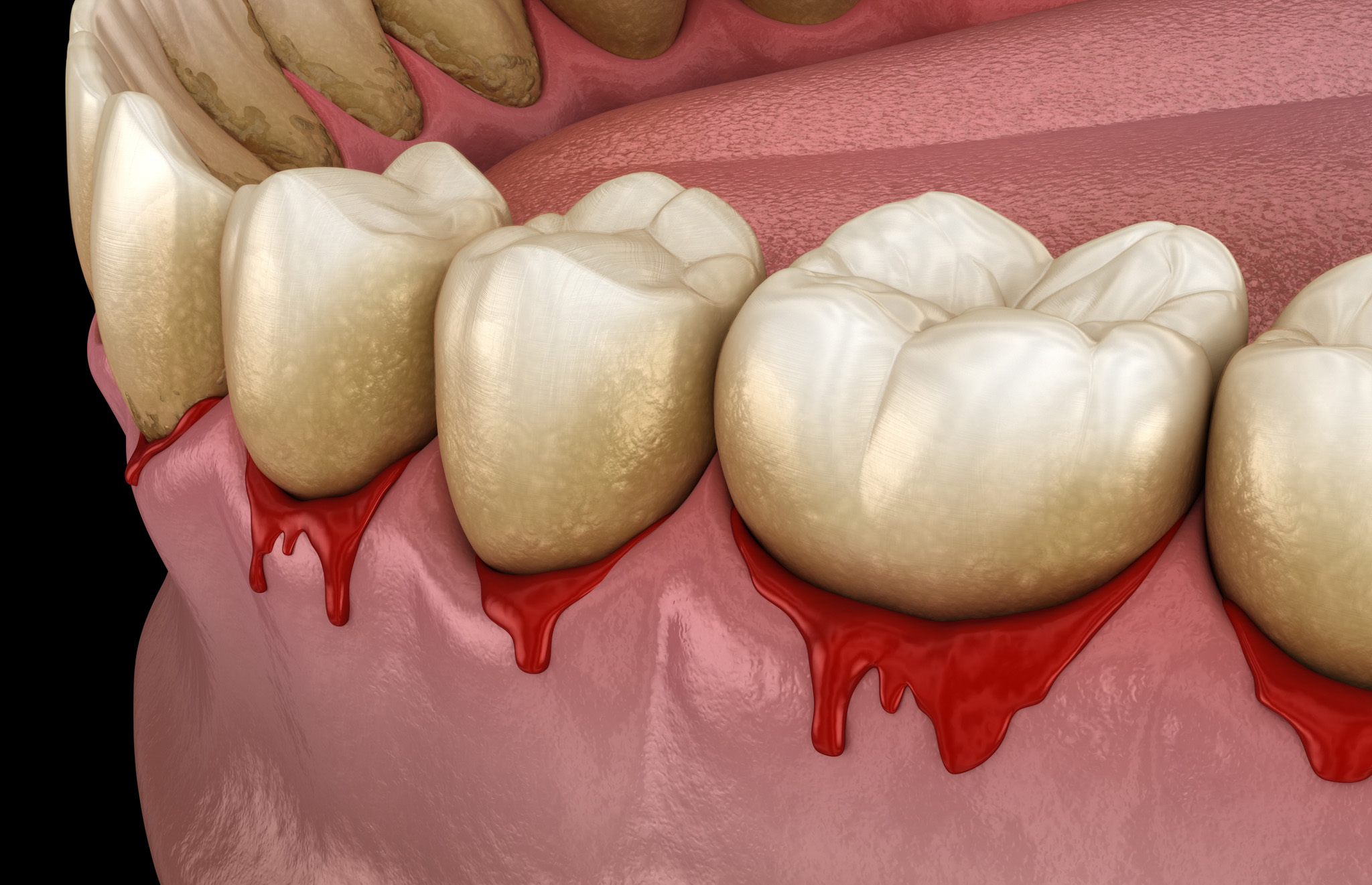 What Causes Gum Disease?